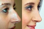 Как сделать красивый нос
