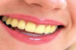 Как избавиться от желтых зубов